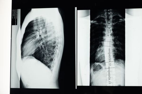 X-ray showing scoliosis spinal curvature treated with Schroth Method rehabilitation